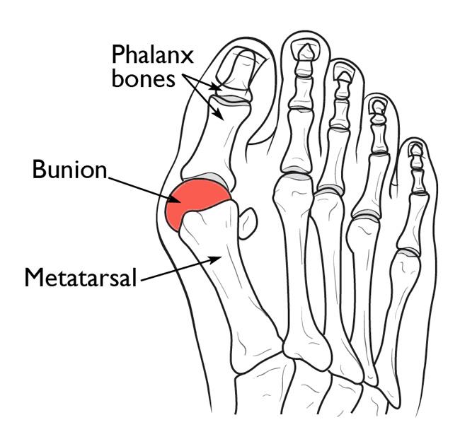 Bunion neww