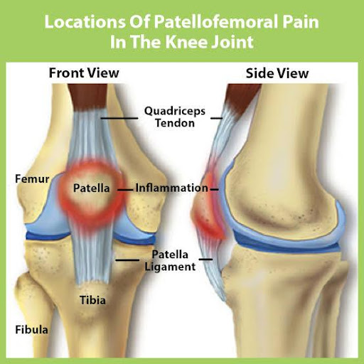 Patellofemoral