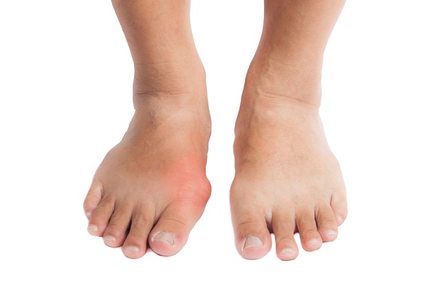 bunion
