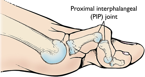 hammer toe
