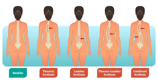 scoliosis types scoliosis types