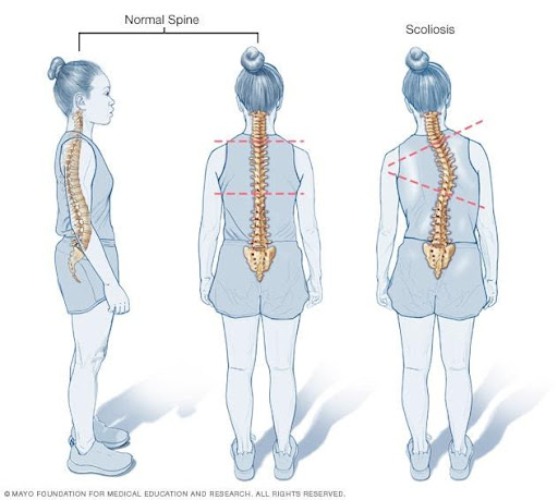 scoliosis1