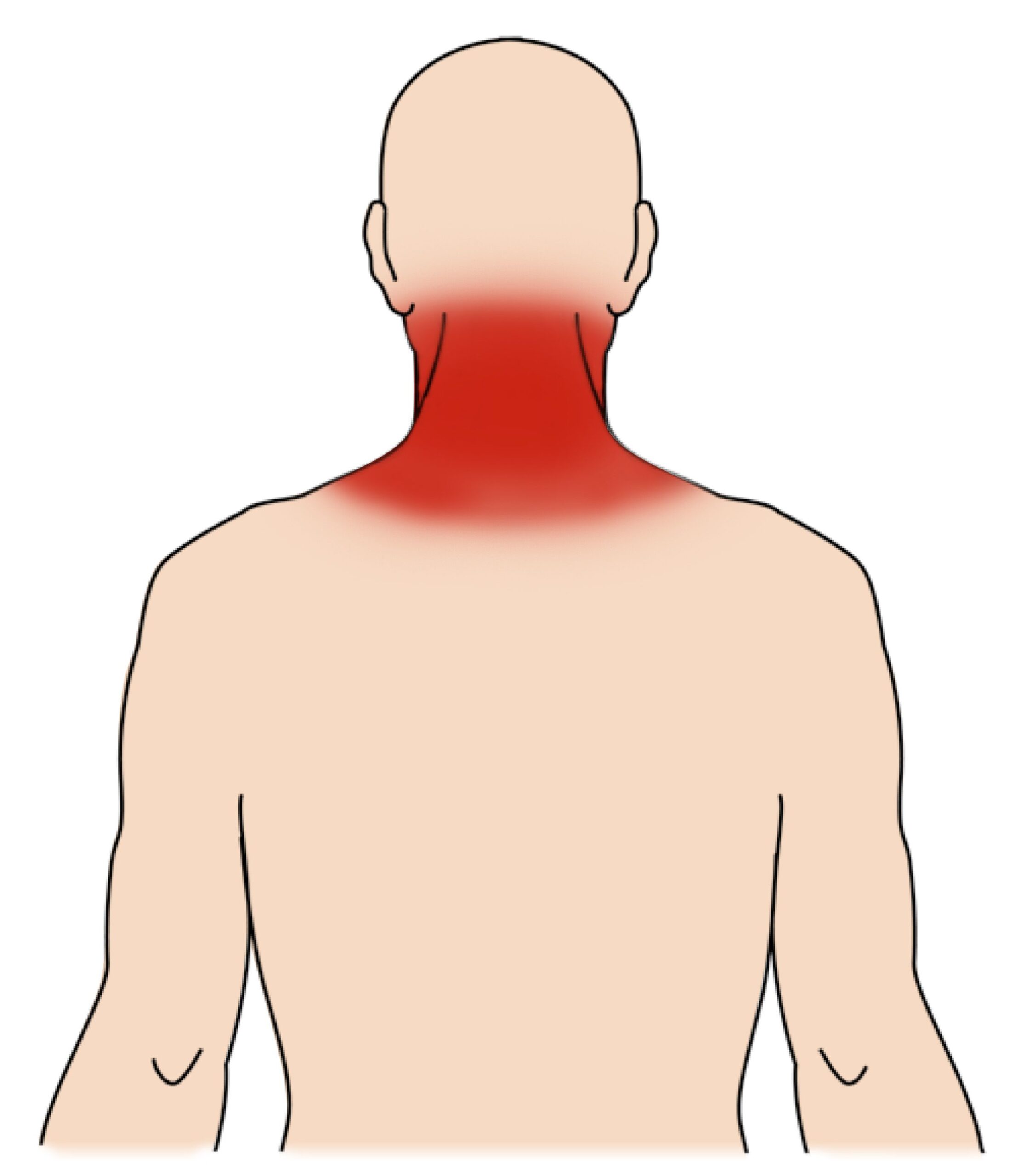 Neck sprain