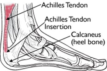 achilles