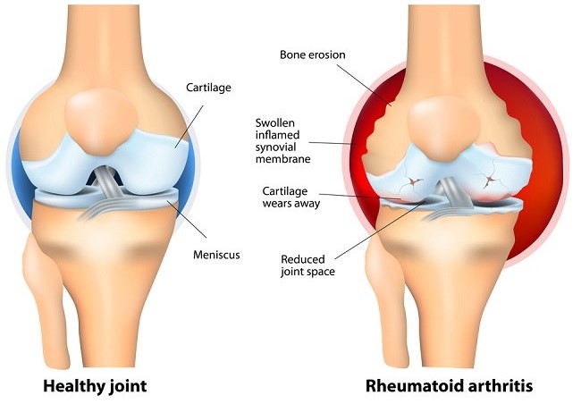 reumatoid-artritis